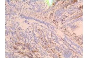 Staining of frozen tissue sections of colon carcinoma using SSEA-4 F8 antibody (Recombinant SSEA-4 antibody)