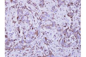 IHC-P Image Immunohistochemical analysis of paraffin-embedded human breast cancer, using Interferon gamma Receptor 1, antibody at 1:250 dilution. (IFNGR1 antibody)