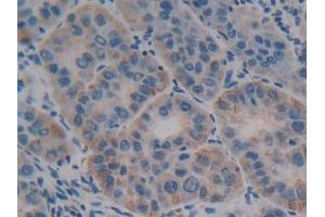 DAB staining on IHC-P; Samples: Human Liver cancer Tissue (Olfactomedin 4 antibody  (AA 407-510))