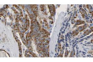 ABIN6267150 at 1/100 staining Human thyroid cancer tissue by IHC-P.