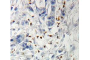 Immunohistochemistry (IHC) image for anti-Insulin-Like Growth Factor 2 mRNA Binding Protein 3 (IGF2BP3) (AA 2-343) antibody (ABIN1868507)