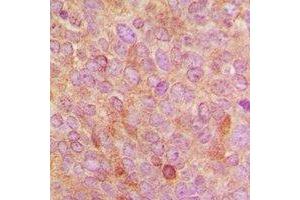 Immunohistochemical analysis of Cytochrome P450 24A1 staining in human breast cancer formalin fixed paraffin embedded tissue section. (CYP24A1 antibody  (C-Term))