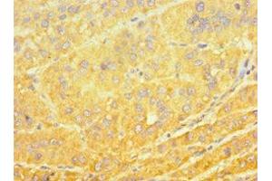 Immunohistochemistry of paraffin-embedded human liver cancer using ABIN7149270 at dilution of 1:100 (CYP4A11 antibody  (AA 1-200))