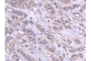 DAB staining on IHC-P; Samples: Human Breast cancer Tissue (DARS antibody  (AA 363-501))
