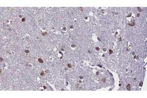 ABIN6268871 at 1/100 staining Human brain cancer tissue by IHC-P. (beta Synuclein antibody  (C-Term))