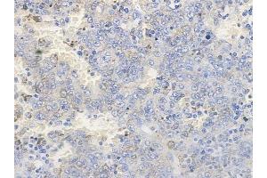 ABIN6256596 and ABIN6267259 at 1/100 staining human melanoma by IHC-P. (EGFR antibody  (pThr669, pTyr693))