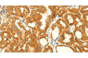 Immunohistochemistry of paraffin-embedded Human thyroid cancer using NAPA Polyclonal Antibody at dilution of 1:35 (NAPA antibody)