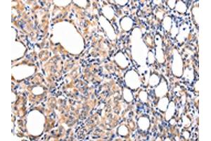 The image on the left is immunohistochemistry of paraffin-embedded Human thyroid cancer tissue using ABIN7190092(CCL7 Antibody) at dilution 1/20, on the right is treated with synthetic peptide. (CCL7 antibody)