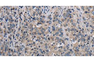 Immunohistochemistry of paraffin-embedded Human liver cancer using MCM3AP Polyclonal Antibody at dilution of 1:30 (GANP antibody)