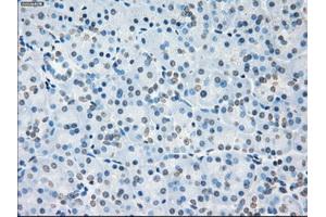 Immunohistochemical staining of paraffin-embedded Adenocarcinoma of colon tissue using anti-SORDmouse monoclonal antibody. (SORD antibody)