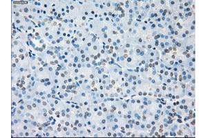 Immunohistochemical staining of paraffin-embedded Adenocarcinoma of colon tissue using anti-SORDmouse monoclonal antibody.