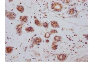 IHC image of ABIN7127365 diluted at 1:100 and staining in paraffin-embedded human breast cancer performed on a Leica BondTM system. (Recombinant BCL2L1 antibody)