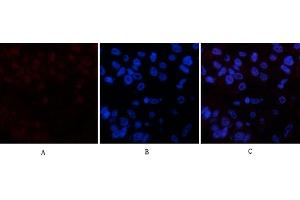 Immunofluorescence analysis of human liver cancer tissue. (PARP1 antibody  (cleaved))