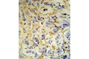 FGA Antibody (N-term) (R) IHC analysis in formalin fixed and paraffin embedded human breast carcinoma tissue followed by peroxidase conjugation of the secondary antibody and DAB staining.