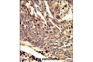 Formalin-fixed and paraffin-embedded human lung carcinoma reacted with ARPC1B Antibody (Center), which was peroxidase-conjugated to the secondary antibody, followed by DAB staining. (ARPC1B antibody  (AA 159-188))