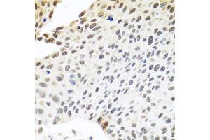 Immunohistochemistry of paraffin-embedded human lung cancer using SKIV2L2 antibody. (MTR4 antibody)