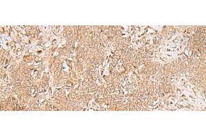 Immunohistochemistry of paraffin-embedded Human ovarian cancer tissue using GMPPB Polyclonal Antibody at dilution of 1:50(x200) (GMPPB antibody)