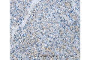 Immunohistochemistry of Human liver cancer using MMP25 Polyclonal Antibody at dilution of 1:80 (MMP25 antibody)