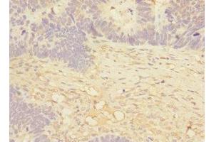 Immunohistochemistry of paraffin-embedded human ovarian cancer using ABIN7160074 at dilution of 1:100
