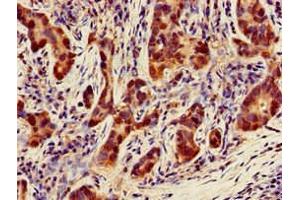 Immunohistochemistry of paraffin-embedded human pancreatic cancer using ABIN7160874 at dilution of 1:100