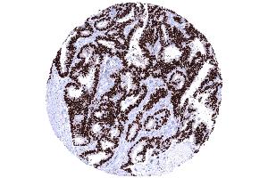 Endometroid carcinoma of the ovary depicting a strong PR immunostaining of all tumor cells (Recombinant Progesterone Receptor antibody  (AA 1-200))