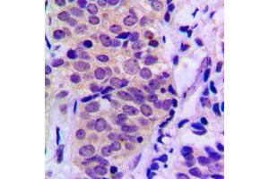 Immunohistochemical analysis of BAD (pS155) staining in human prostate cancer formalin fixed paraffin embedded tissue section. (BAD antibody  (C-Term, pSer155))