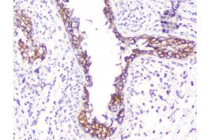 IHC testing of FFPE human breast cancer with Beta Catenin antibody. (beta Catenin antibody  (AA 2-233))