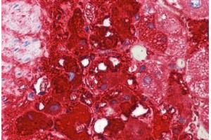 Human Adrenal (formalin-fixed, paraffin-embedded) stained with TH antibody ABIN462131 followed by biotinylated goat anti-rabbit IgG secondary antibody ABIN481713, alkaline phosphatase-streptavidin and chromogen. (Tyrosine Hydroxylase antibody)