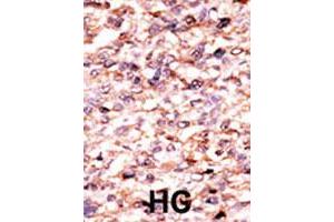 Formalin-fixed and paraffin-embedded human hepatocellular carcinoma tissue reacted with ACVR1C polyclonal antibody  , which was peroxidase-conjugated to the secondary antibody, followed by AEC staining. (ACVR1C/ALK7 antibody  (N-Term))