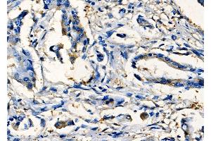 ABIN6265096 and ABIN6277789 at 1/100 staining Human colorectal cancer by IHC-P.