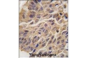 Formalin-fixed and paraffin-embedded human lung carcinoma tissue reacted with INDO antibody (C-term) (ABIN389194 and ABIN2839357) , which was peroxidase-conjugated to the secondary antibody, followed by DAB staining. (IDO1 antibody  (C-Term))