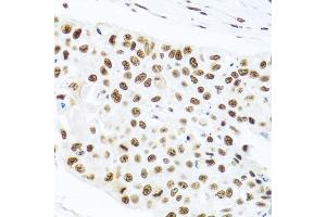 Immunohistochemistry of paraffin-embedded human lung cancer using PRPF19 antibody. (PRP19 antibody)