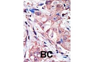 Formalin-fixed and paraffin-embedded human cancer tissue reacted with the primary antibody, which was peroxidase-conjugated to the secondary antibody, followed by AEC staining. (MAPK10 antibody  (N-Term))