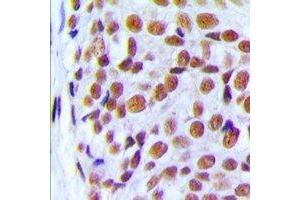 Immunohistochemical analysis of PRPF6 staining in human breast cancer formalin fixed paraffin embedded tissue section. (PRP6/ANT-1 antibody  (C-Term))