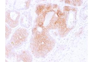 Formalin-fixed, paraffin-embedded human Prostate Carcinoma stained with CD44v6 Mouse Monoclonal Antibody (CD44V6/2496). (CD44 antibody)
