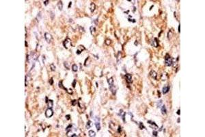 IHC analysis of FFPE human hepatocarcinoma tissue stained with the GCN2 antibody