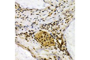 Immunohistochemistry of paraffin-embedded human colon carcinoma using IFIH1 antibody (ABIN5971229) at dilution of 1/200 (40x lens). (IFIH1 antibody)