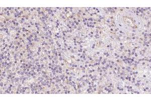 ABIN6273088 at 1/100 staining Human lymph cancer tissue by IHC-P. (ACADVL antibody  (Internal Region))