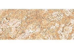 Immunohistochemistry of paraffin-embedded Human ovarian cancer tissue using TRMT112 Polyclonal Antibody at dilution of 1:30(x200) (TRMT112 antibody)