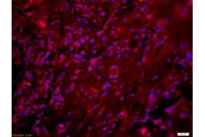 Formalin-fixed and paraffin-embedded human breast carcinoma labeled with Anti-Phospho-NFKB p65(Ser276) Polyclonal Antibody, Unconjugated (ABIN700555) 1:200, overnight at 4°C, The secondary antibody was Goat Anti-Rabbit IgG, Cy3 conjugated used at 1:200 dilution for 40 minutes at 37°C. (NF-kB p65 antibody  (pSer276))