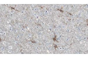 ABIN6274635 at 1/100 staining Human brain cancer tissue by IHC-P. (Aromatase antibody  (Internal Region))