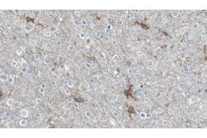 ABIN6274635 at 1/100 staining Human brain cancer tissue by IHC-P.