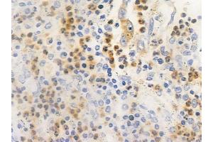 ABIN6261154 and ABIN6266525 at 1/100 staining human colon carcinoma by IHC-P. (Cyclin G1 antibody  (Internal Region))