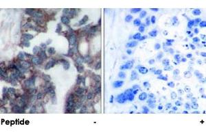 Immunohistochemical analysis of paraffin-embedded human breast carcinoma tissue using RPS6KB1 polyclonal antibody . (RPS6KB1 antibody)