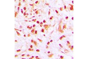 Immunohistochemical analysis of Histone H4 (AcK8) staining in human lung cancer formalin fixed paraffin embedded tissue section. (Histone H4 antibody  (acLys8, N-Term))