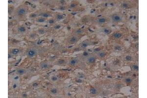 Detection of SHH in Human Liver cancer Tissue using Polyclonal Antibody to Hedgehog Homolog, Sonic (SHH) (Sonic Hedgehog antibody  (AA 36-193))