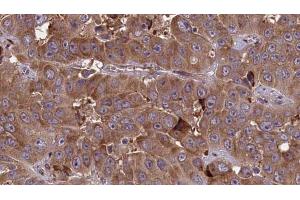 ABIN6273702 at 1/100 staining Human liver cancer tissue by IHC-P.