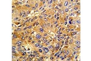 IHC analysis of FFPE human hepatocarcinoma with Cyclin A2 antibody (Cyclin A antibody  (AA 51-84))