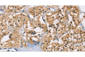 Immunohistochemistry of paraffin-embedded Human thyroid cancer using PPP3CA Polyclonal Antibody at dilution of 1:40 (PPP3CA antibody)