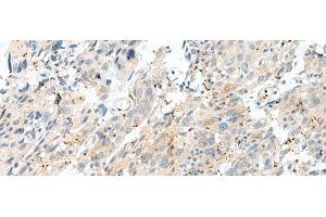 Immunohistochemistry of paraffin-embedded Human cervical cancer tissue using NXNL1 Polyclonal Antibody at dilution of 1:45(x200) (NXNL1 antibody)